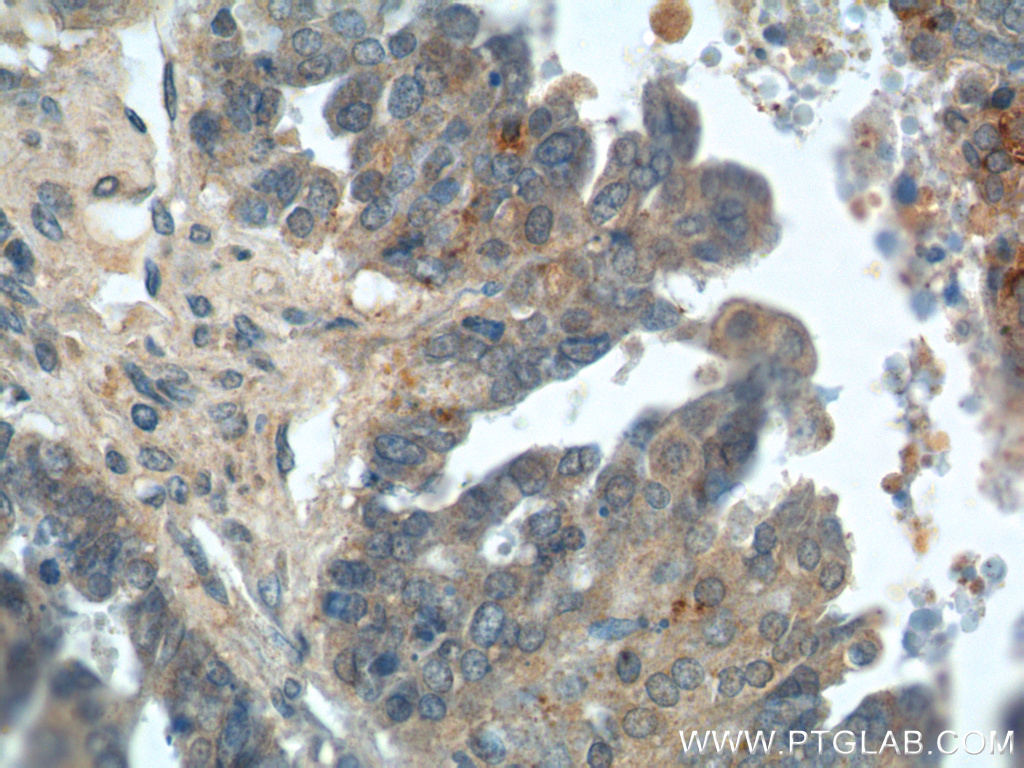 14232-1-AP;human ovary tumor tissue