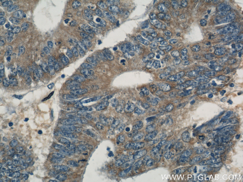 10785-1-AP;human colon cancer tissue