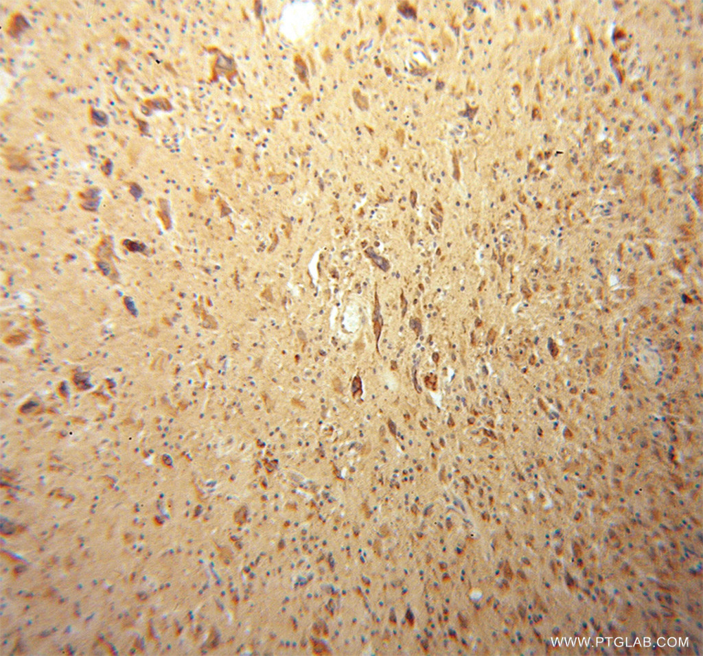 13845-1-AP;Gliomas