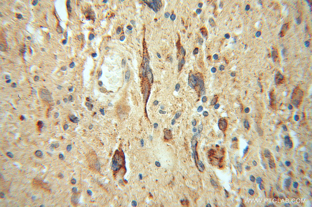 13845-1-AP;Gliomas