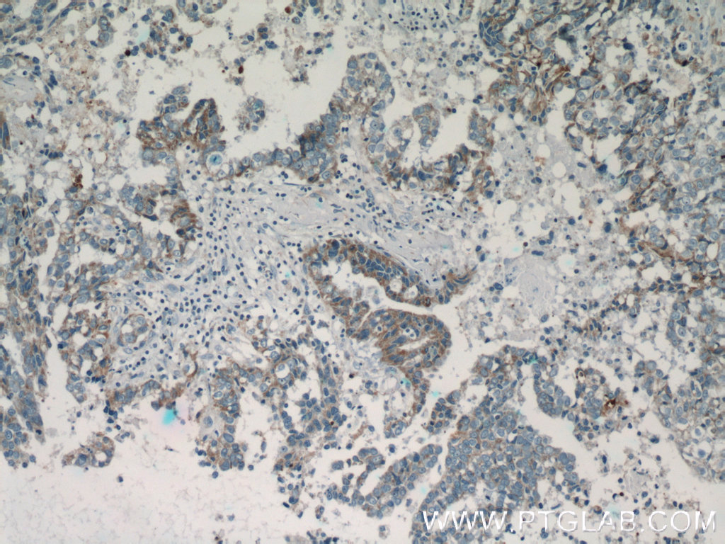 51142-1-AP;human breast cancer tissue