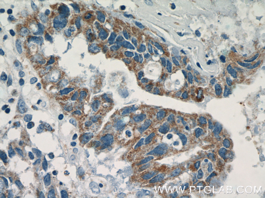 51142-1-AP;human breast cancer tissue