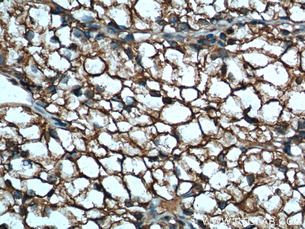 15904-1-AP;human renal cell carcinoma tissue