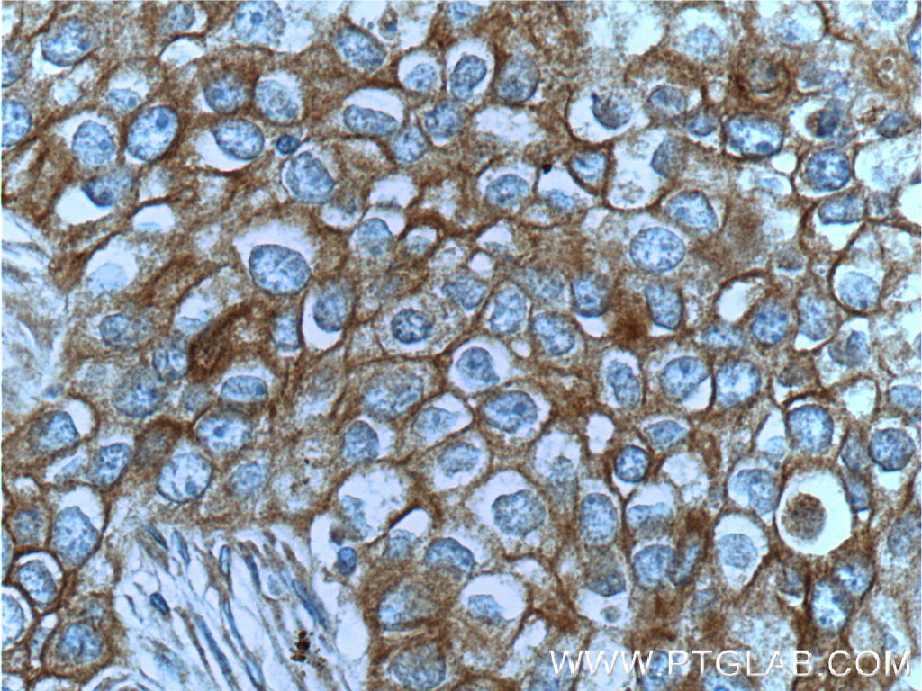 25869-1-AP;human breast cancer tissue