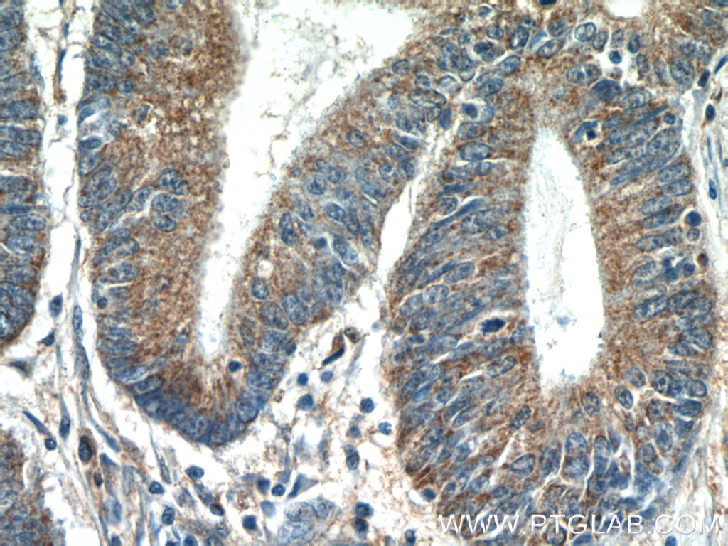 17679-1-AP;human colon cancer tissue