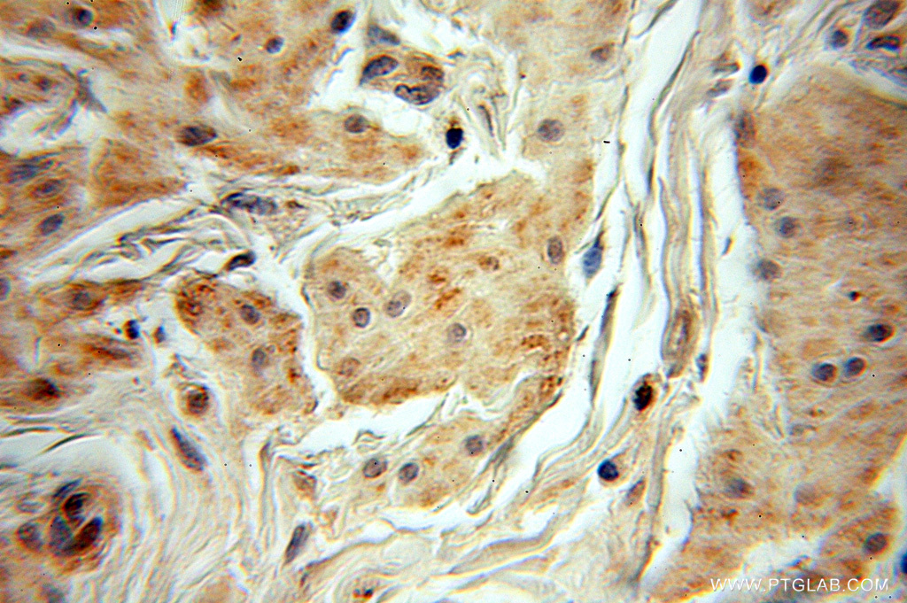 11151-1-AP;Ovary tumor