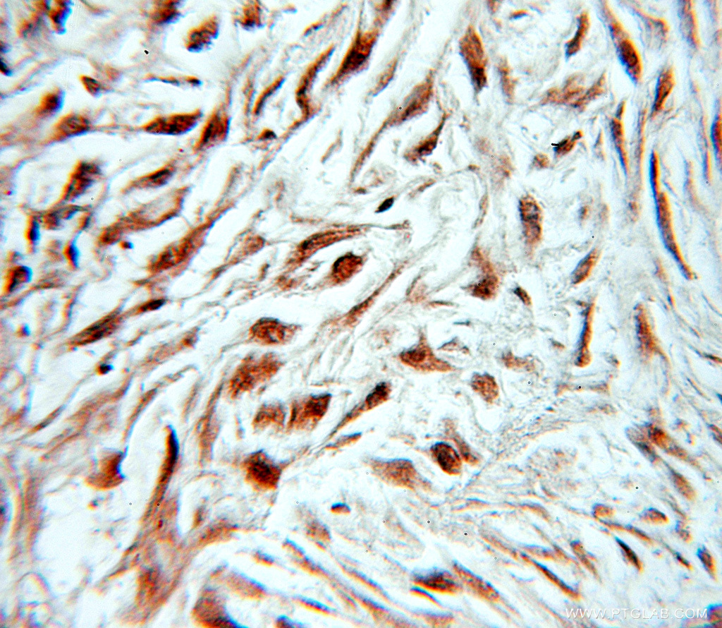 10770-1-AP;human ovary tumor tissue