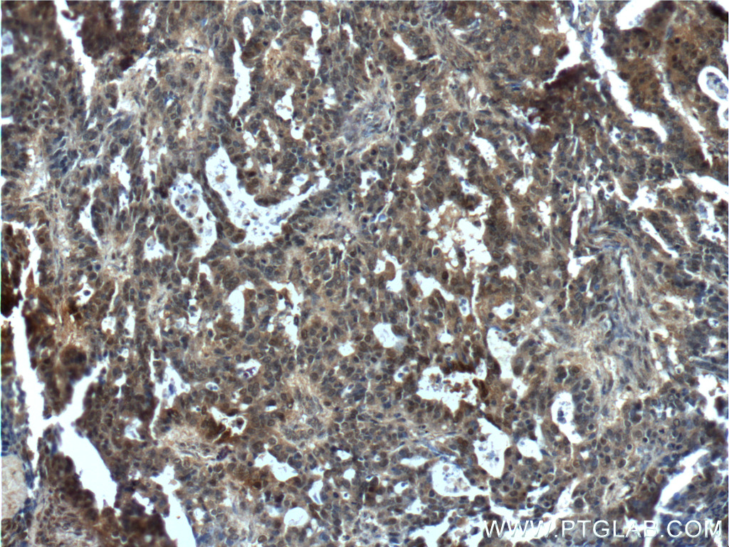15163-1-AP;human ovary tumor tissue