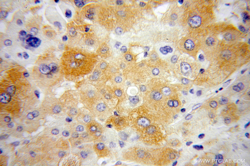 14882-1-AP;Liver cancer