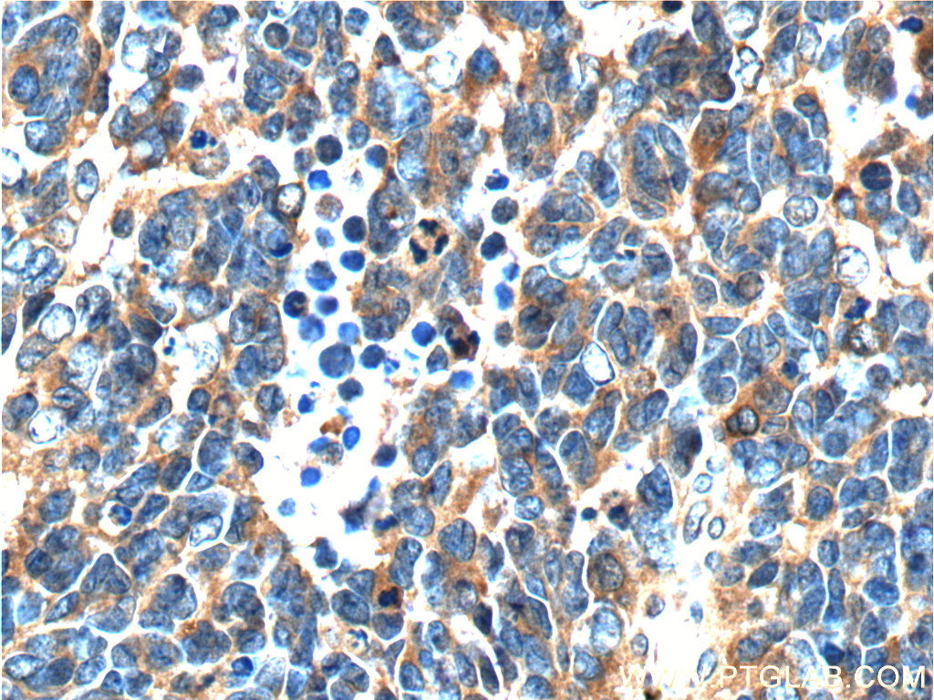 12184-1-AP;human medulloblastoma tissue