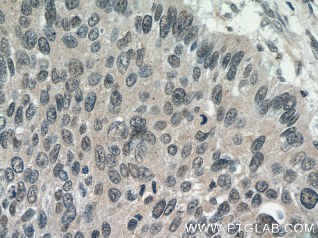 15802-1-AP;human cervical cancer tissue