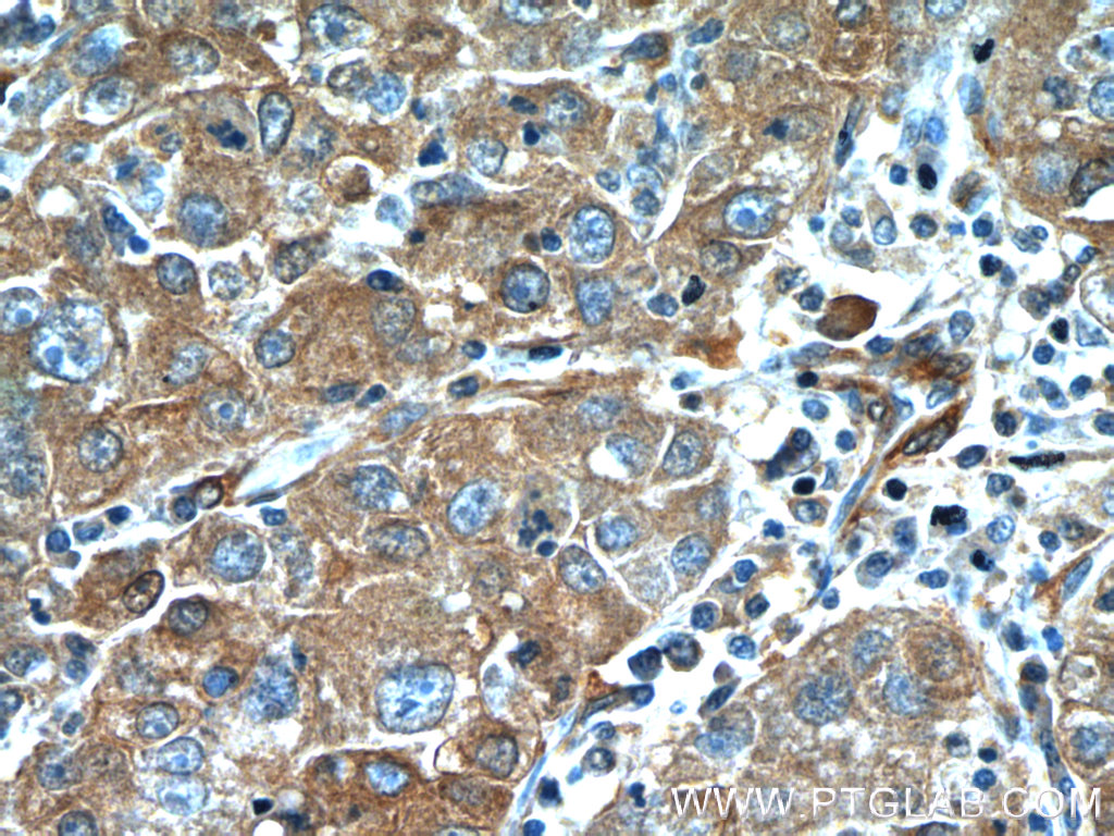 25248-1-AP;human liver cancer tissue