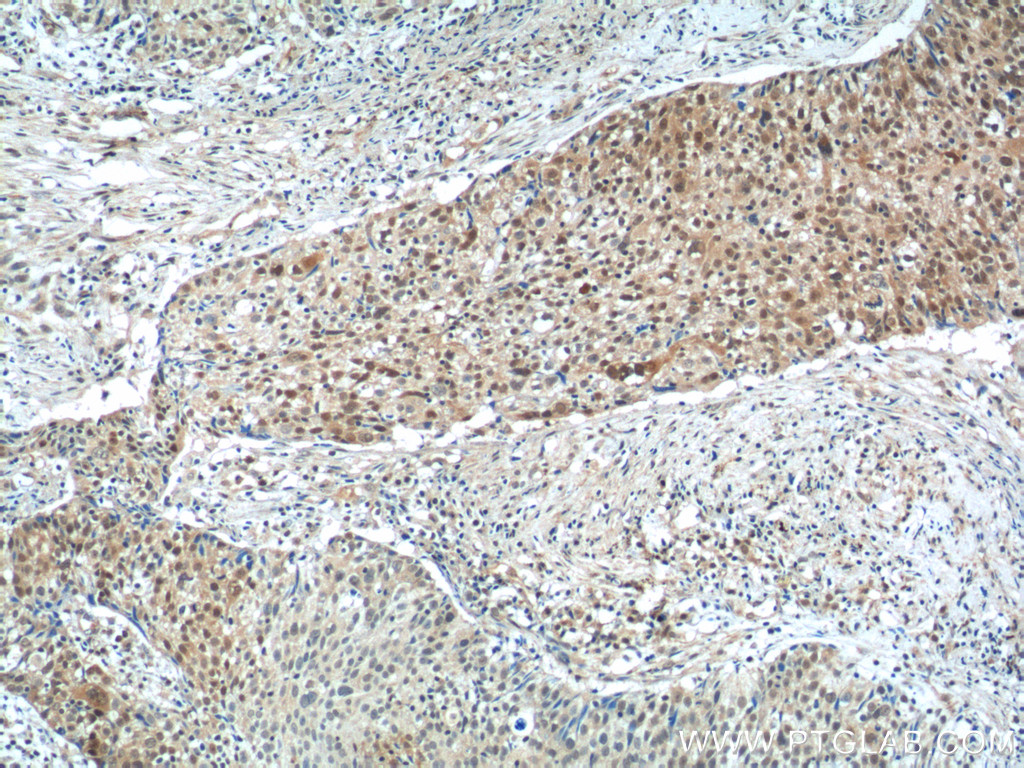 15620-1-AP;human lung cancer tissue