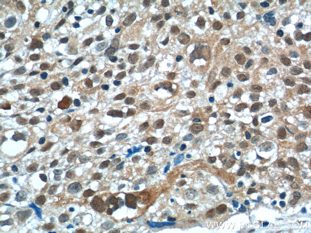 15620-1-AP;human lung cancer tissue