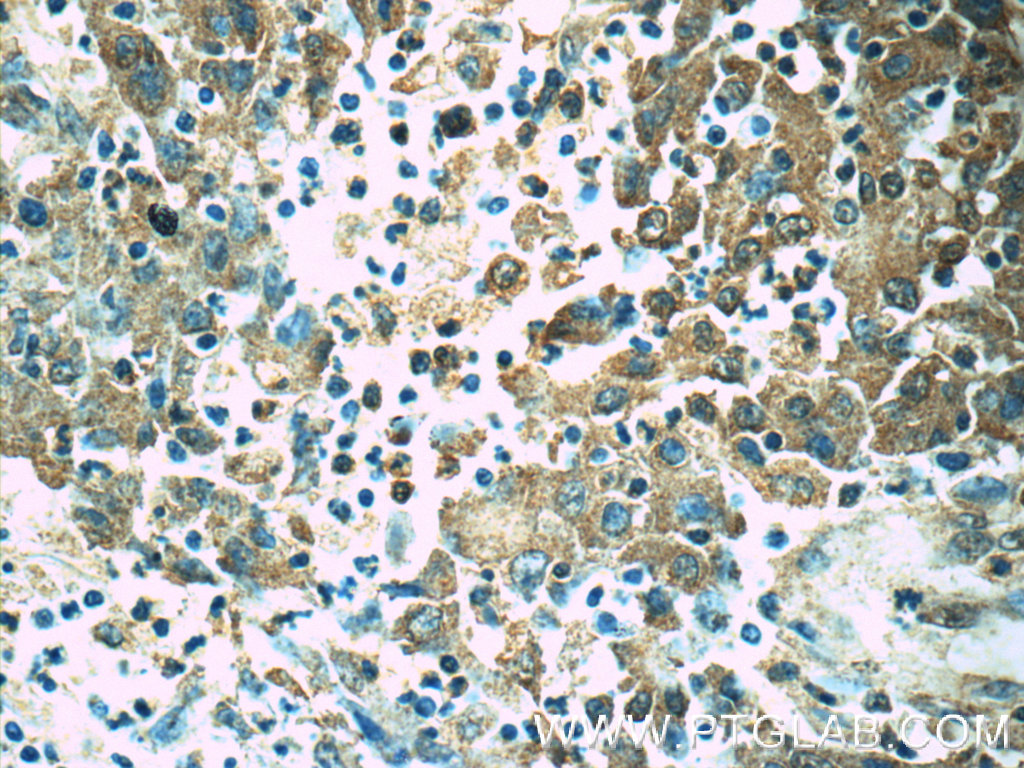 14443-1-AP;human colon cancer tissue