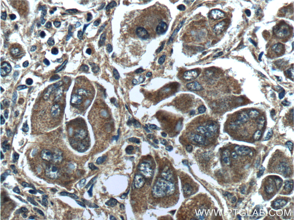 16347-1-AP;human liver cancer tissue