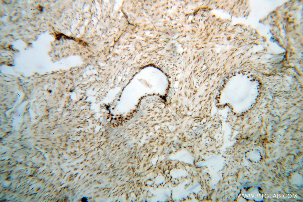 14708-1-AP;human ovary tumor tissue