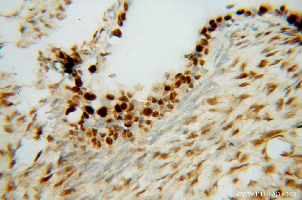 14708-1-AP;human ovary tumor tissue