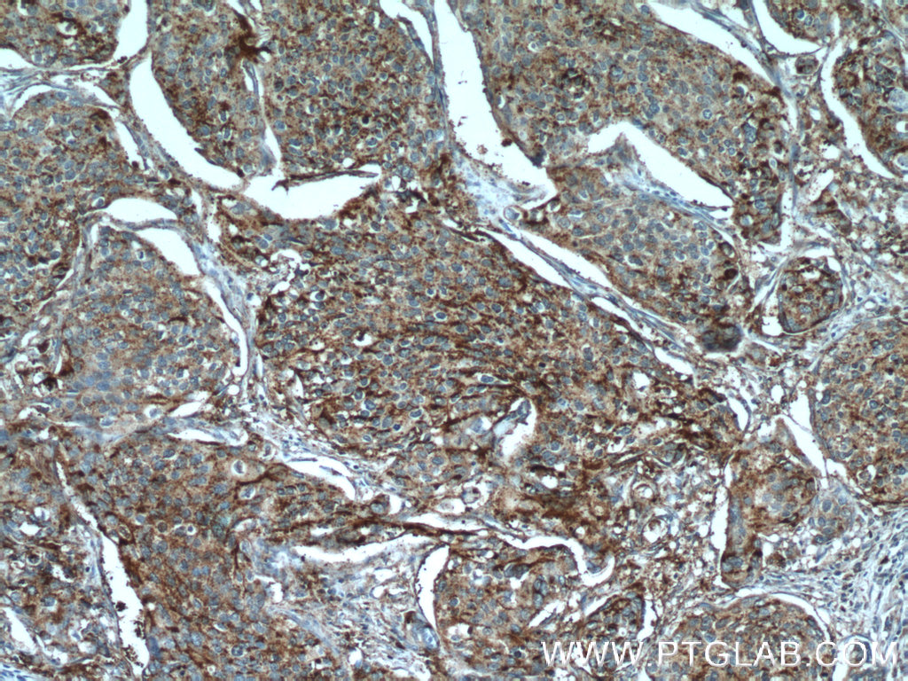 21935-1-AP;human cervical cancer tissue