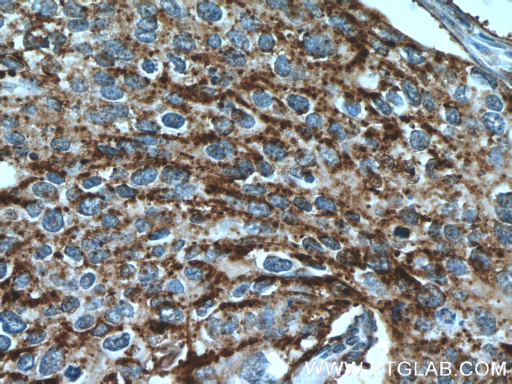 21935-1-AP;human cervical cancer tissue