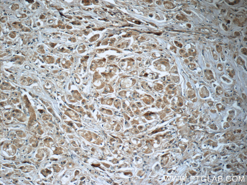 55087-1-AP;human breast cancer tissue