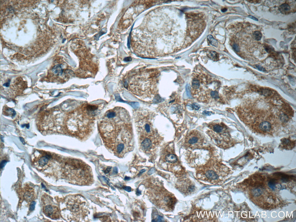 55087-1-AP;human breast cancer tissue