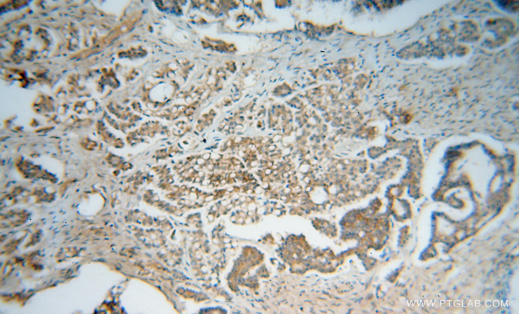 15154-1-AP;human ovary tumor