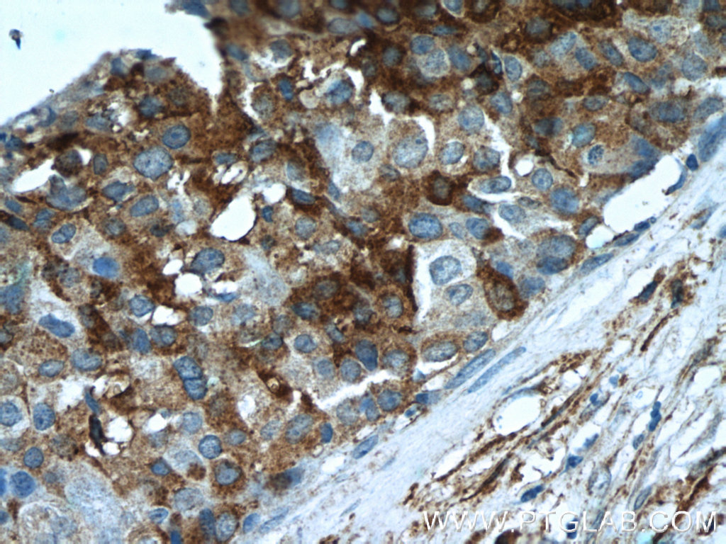 22172-1-AP;human breast cancer tissue