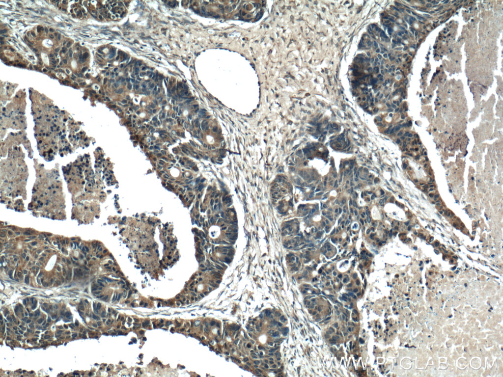 13412-1-AP;human pancreas cancer tissue