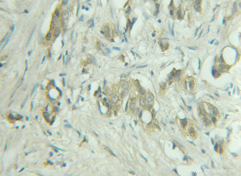 11420-1-AP;human prostate cancer tissue