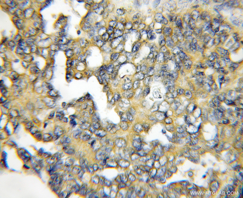 11921-1-AP;human ovary tumor tissue