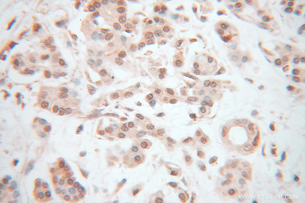 14613-1-AP;human pancreas cancer