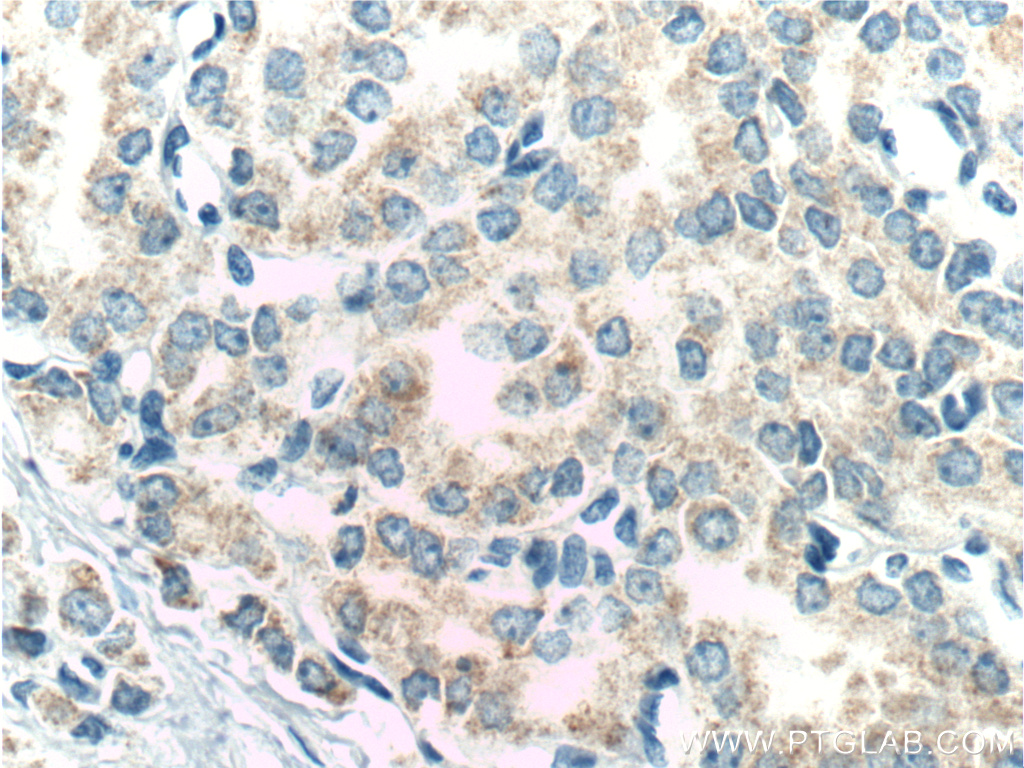 11077-1-AP;human prostate cancer tissue