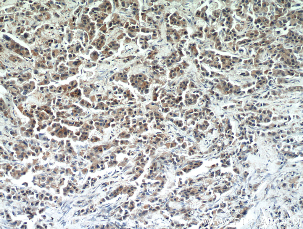 10687-1-AP;human breast cancer tissue