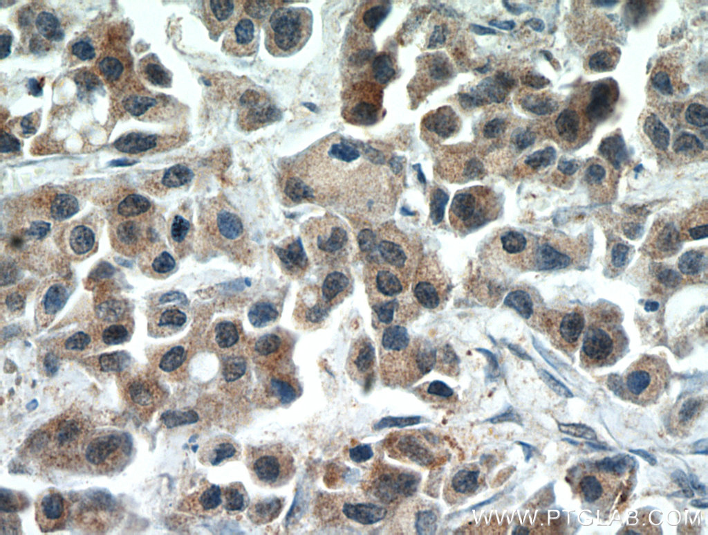 10687-1-AP;human breast cancer tissue