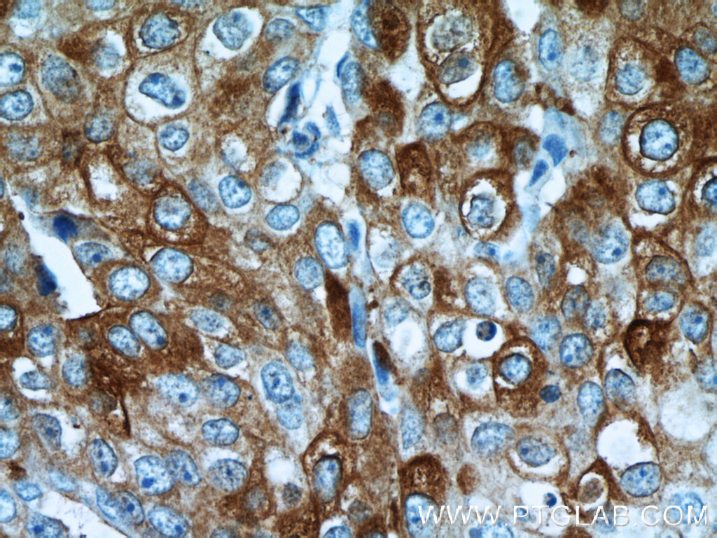 20629-1-AP;human breast cancer tissue