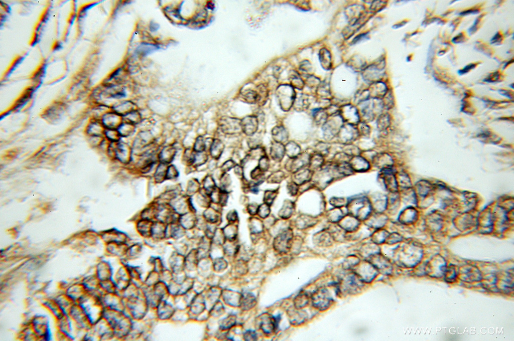 11397-1-AP;human pancreas cancer tissue