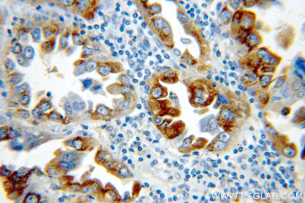 10774-1-AP;human lung cancer tissue