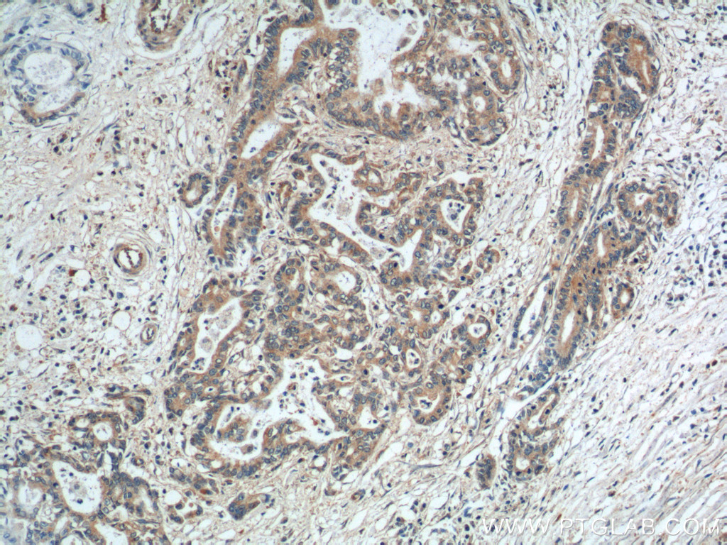 14184-1-AP;human pancreas cancer tissue