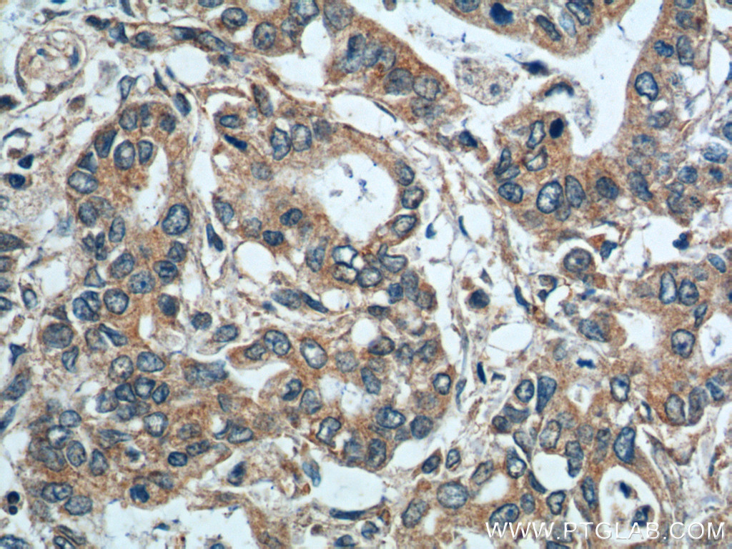 14184-1-AP;human pancreas cancer tissue