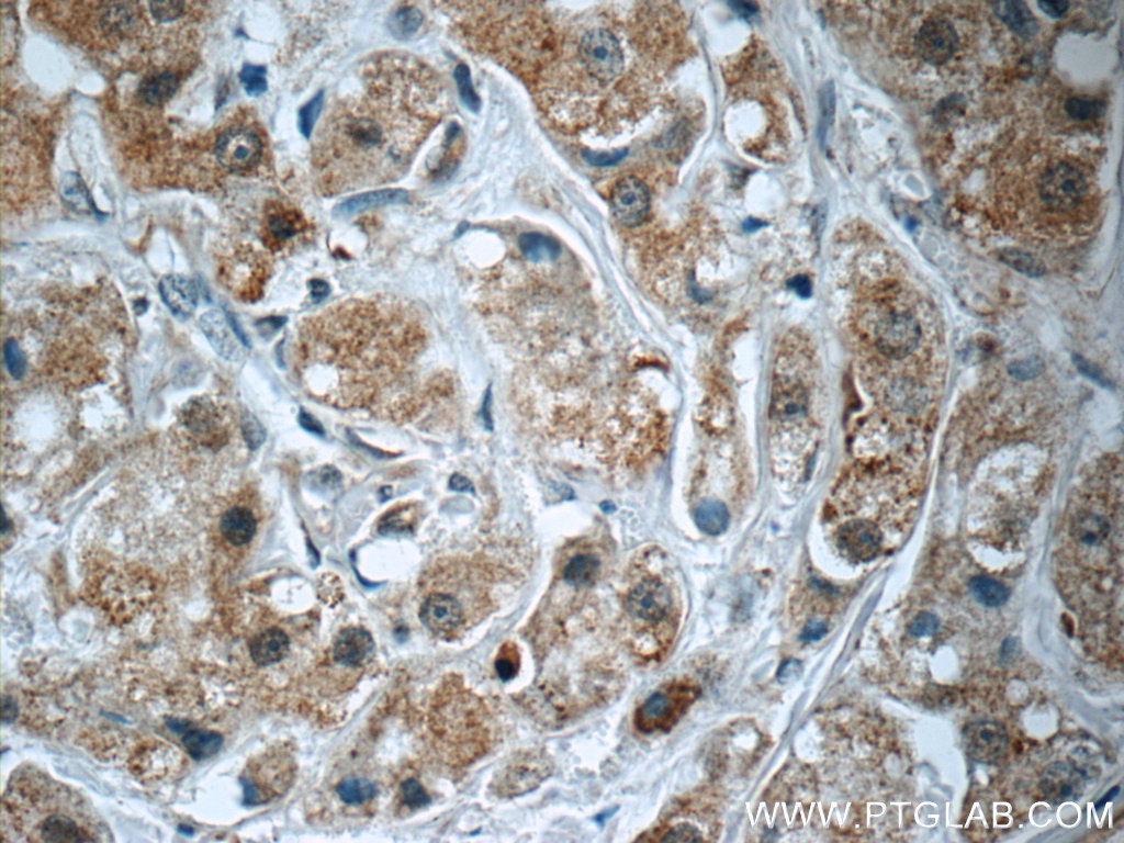 12544-1-AP;human breast cancer tissue