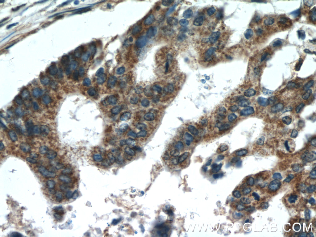 11981-1-AP;human pancreas cancer tissue