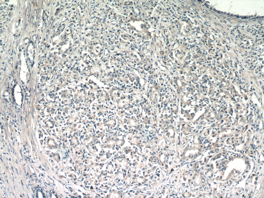 16722-1-AP;human prostate cancer tissue