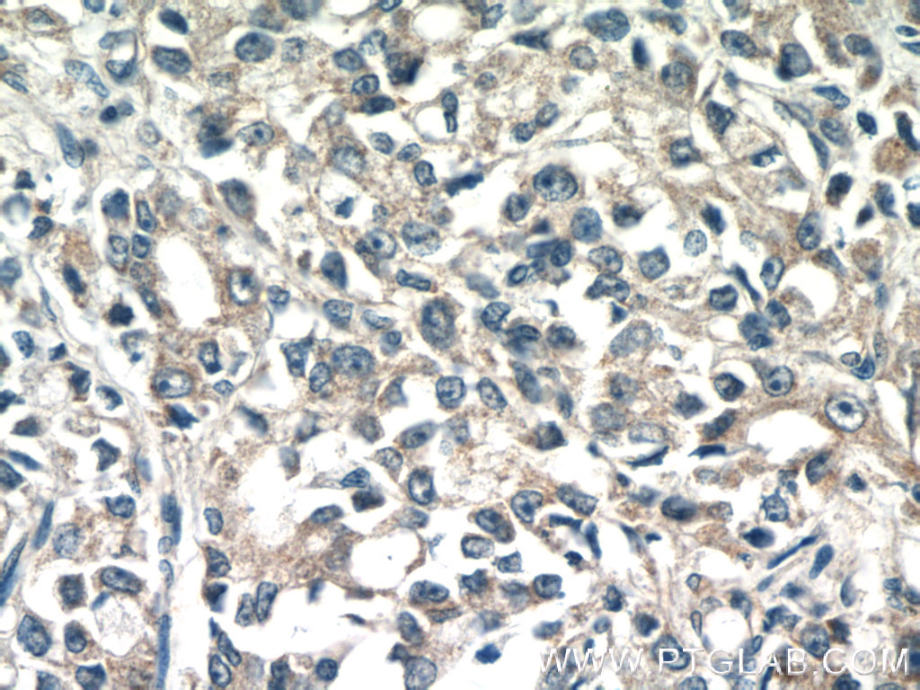 16722-1-AP;human prostate cancer tissue