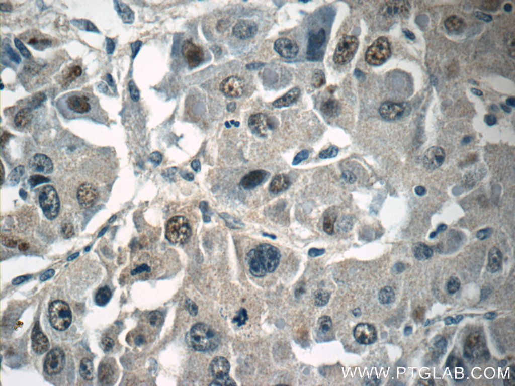 15541-1-AP;human liver cancer tissue