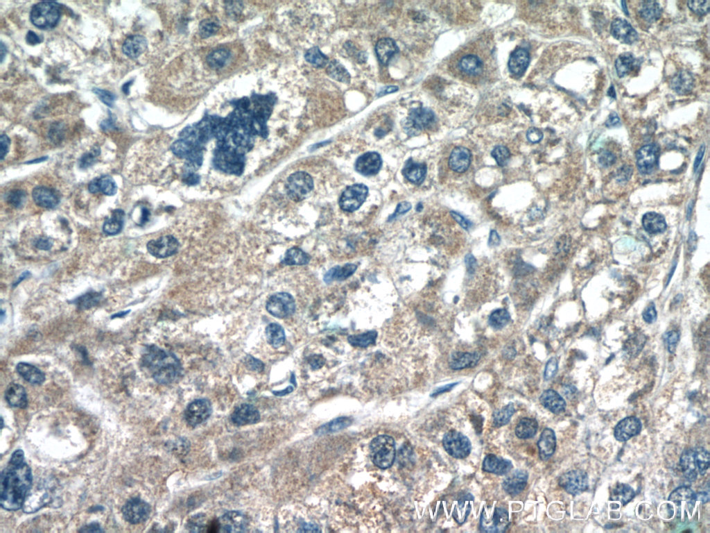 25781-1-AP;human liver cancer tissue