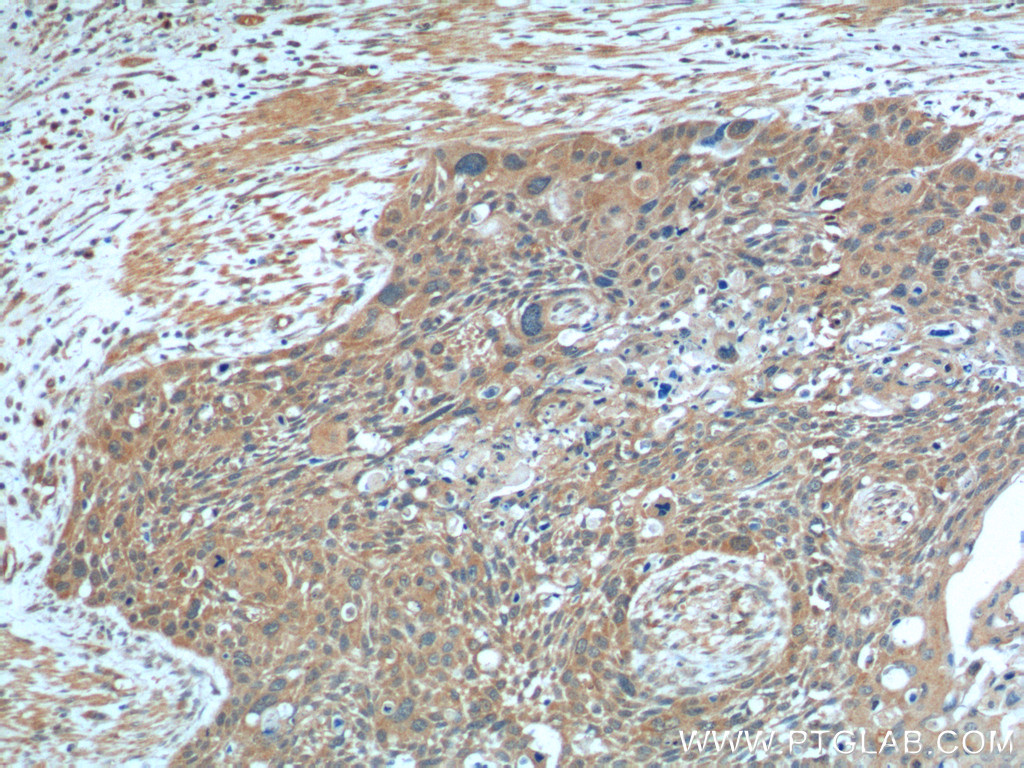 26415-1-AP;human oesophagus cancer tissue