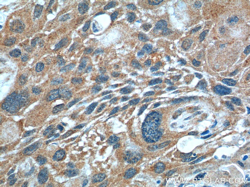 26415-1-AP;human oesophagus cancer tissue