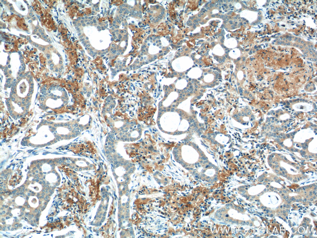 55184-1-AP;human lung cancer tissue