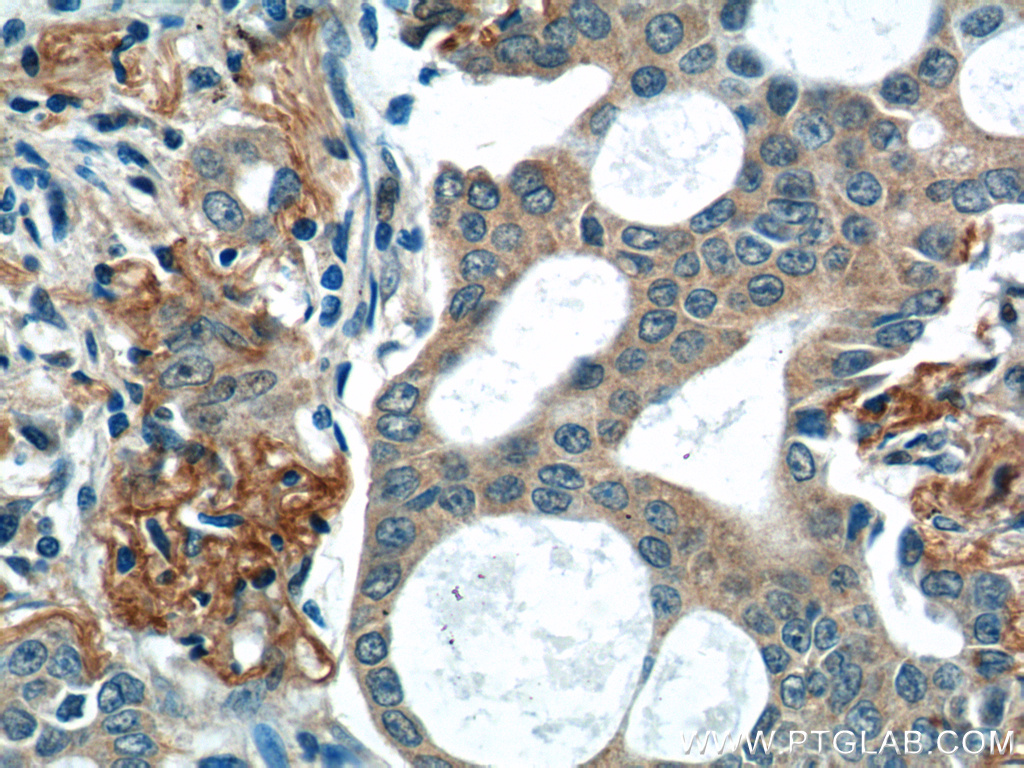 55184-1-AP;human lung cancer tissue